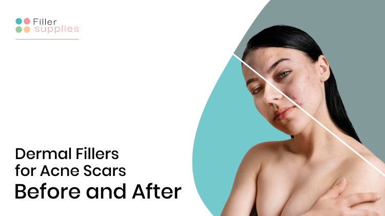 Dermal Fillers for Acne Scars Before and After