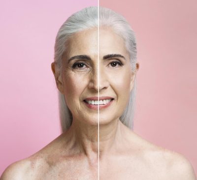 facial aging restylane