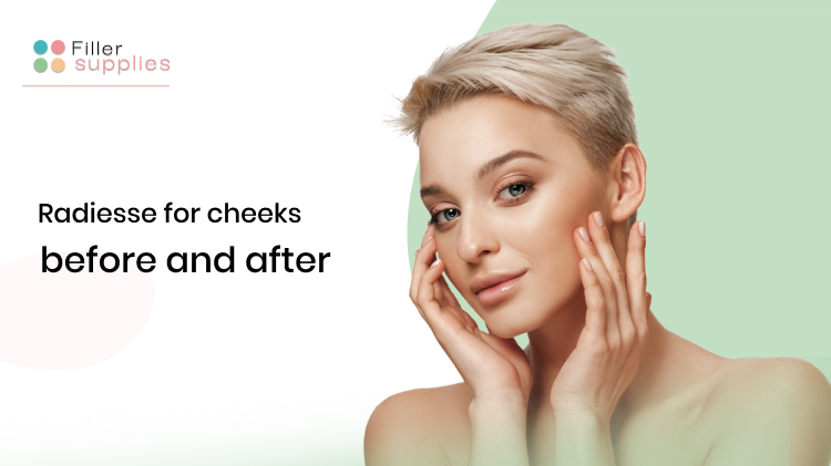 radiesse for cheeks before and after