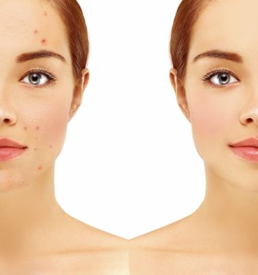 Revolax treatment: Before and After