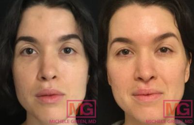 Restylane eyelight Under Eye Circles Enlightening before and after