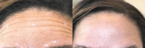 Botox frownlines before and after