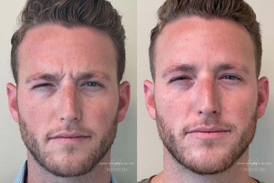 botox glabella before and after