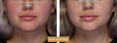juvederm lip augmentation before and after