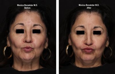 juvederm lip line before and after