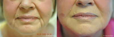 juvederm vertical lips line before and after 2