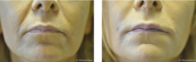 juvederm vertical lips line before and after