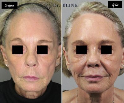 harmonyca before and after results