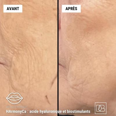 harmonyca before and after sagging treatment