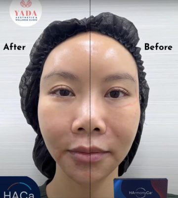 harmonyca filler before and after