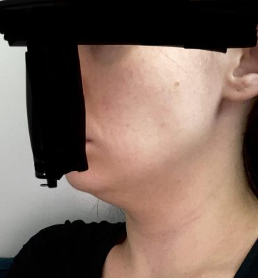 sculptra for neck results