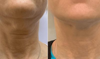 Radiesse Neck Before and After photo 1