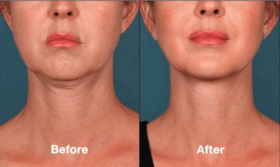Radiesse Neck Before and After photo 2