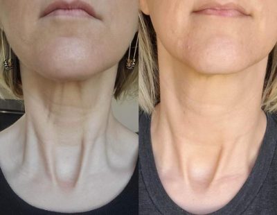 Radiesse Neck Before and After picture