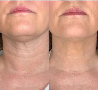 Radiesse Neck Before and After picture 2